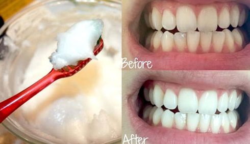 Có nhiều cách làm sạch cao răng bằng các nguyên liệu thiên nhiên