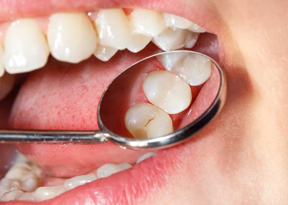 Nên khám răng định kỳ để tránh tình trạng răng bị sâu gây đau nhức