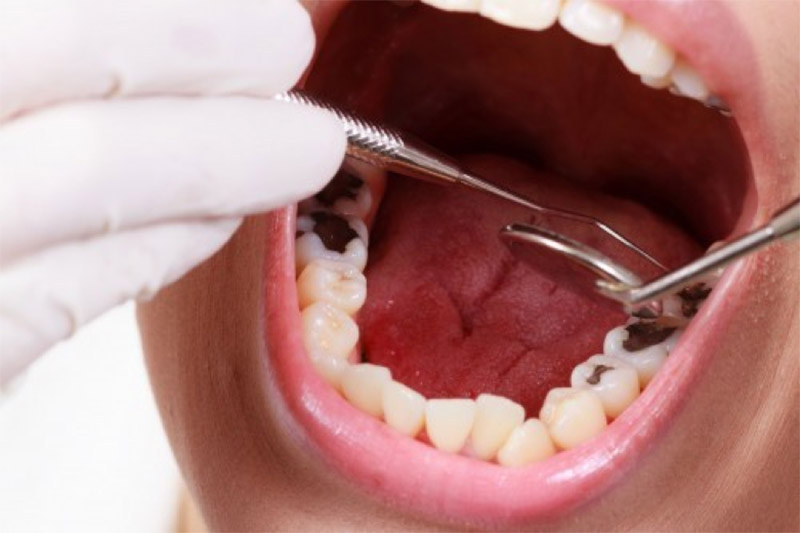 Nên định khám răng định kì để tránh tình trạng đau nhức do sâu răng