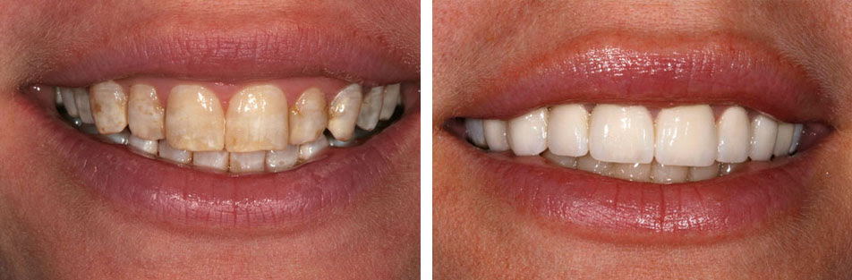 Có nhiều phương pháp hỗ trợ làm đẹp cho răng bị thiếu sản men răng