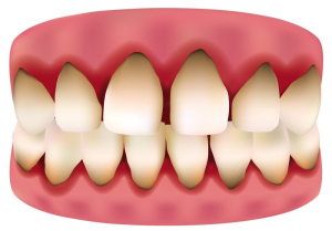 Tại sao viền chân răng bị đen và 5 cách khắc phục hiệu quả nhất