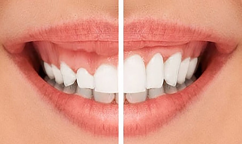 Răng trước và sau khi chữa cười hở lợi