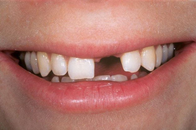 Nên khôi phục lại răng cửa bị mất bằng phương pháp nào