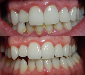 5 mẹo lấy cao răng tại nhà đơn giản mà hiệu quả tối ưu