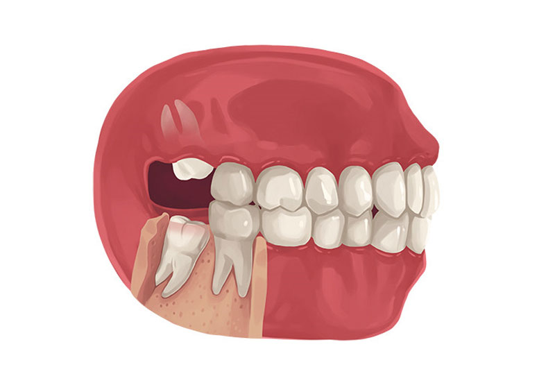 Khi nào nên nhổ răng khôn và nên nhổ răng khôn ở đâu ?