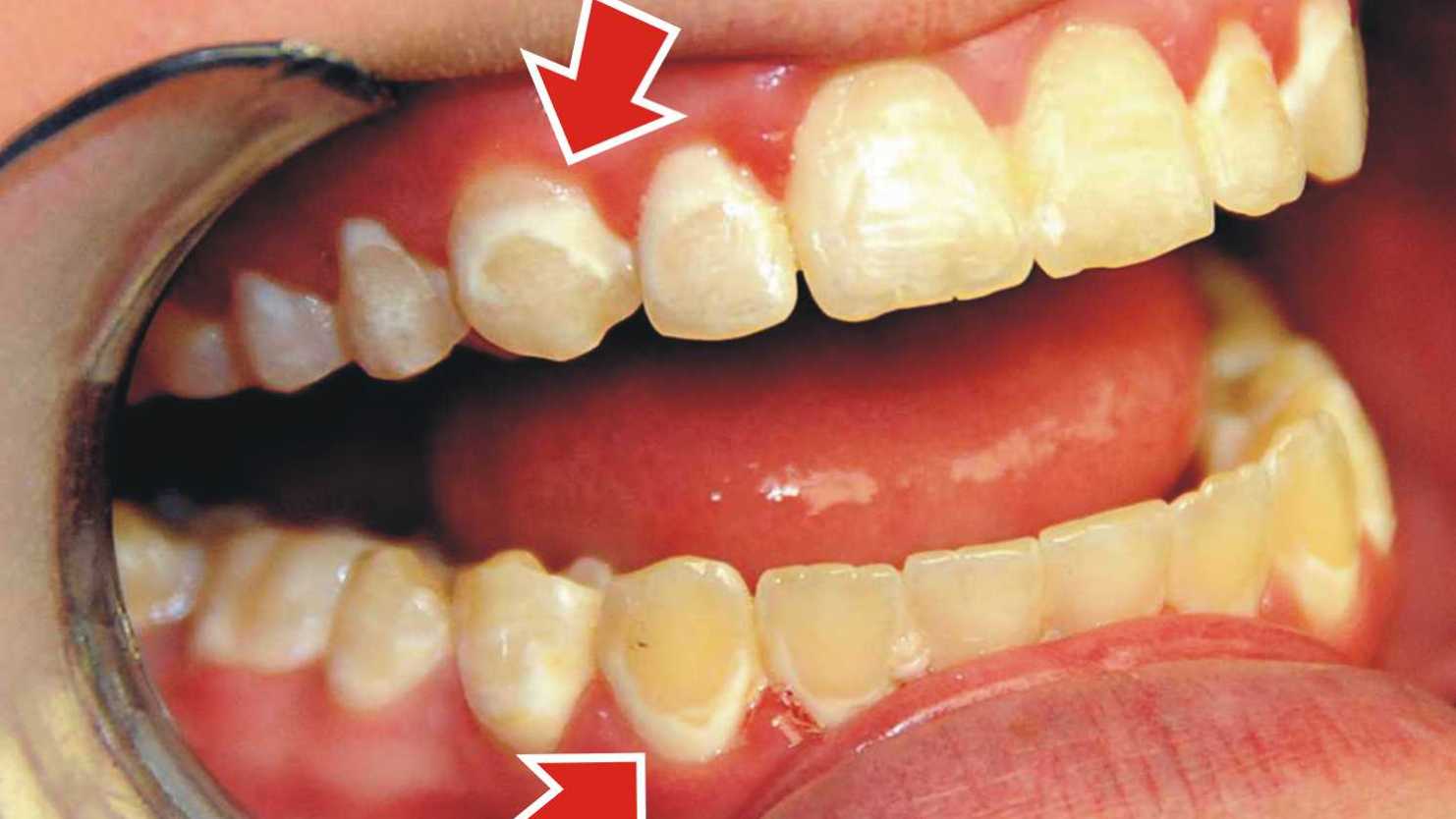 Những dấu hiệu thiếu sản men răng rất dễ nhận biết