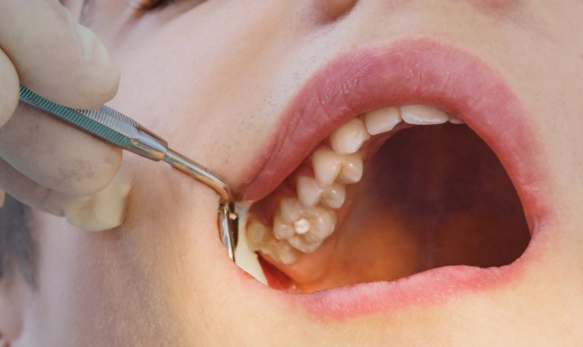 Răng khôn mọc ngầm – Đừng đợi đến khi đau mới đi nhổ