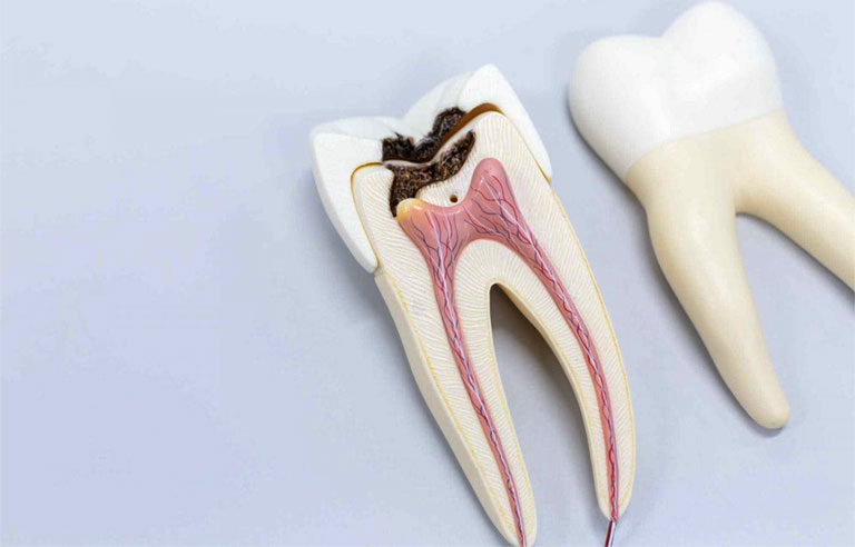 Cách làm dịu cơn đau áp xe răng 