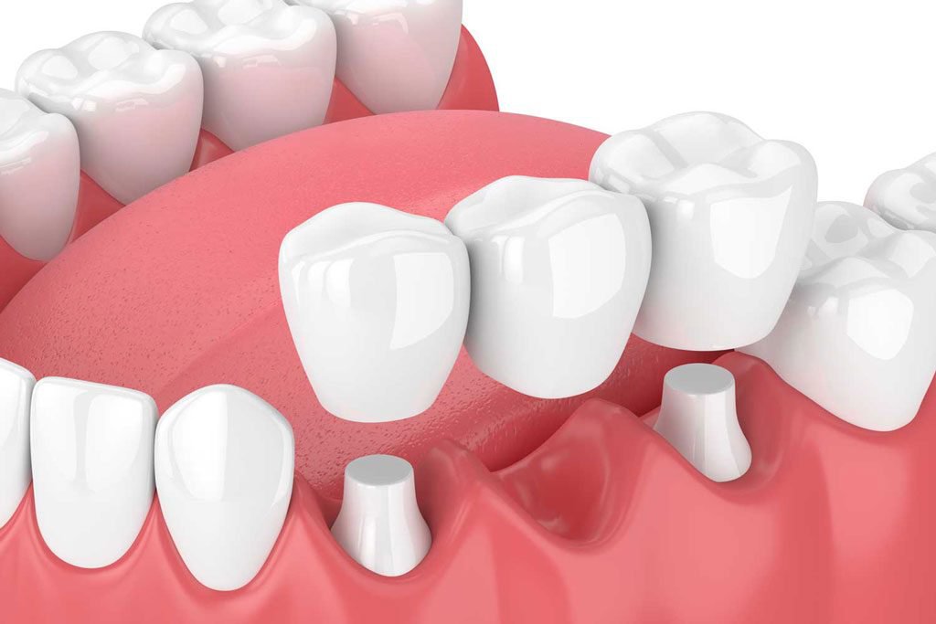 Cấy ghép răng số 6 bằng cầu răng sứ