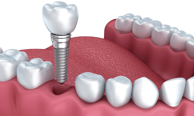 Cấy ghép răng implant ngày càng phổ biến 