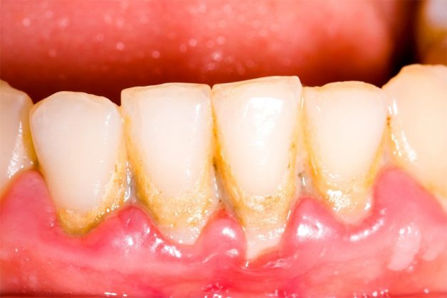 Răng bị vàng do cao răng