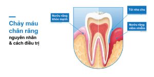 Chảy máu chân răng là biểu hiện của bệnh gì và cách điều trị