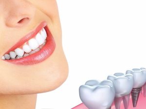 Lời khuyên của bác sĩ chuyên khoa chăm sóc răng Implant sau cấy ghép