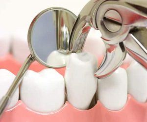 Cách giảm đau hiệu quả sau nhổ răng khi chỉnh nha 