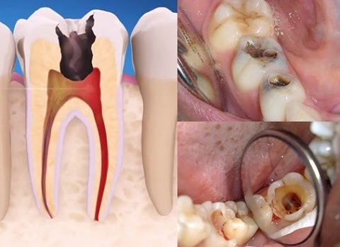 Bị viêm tủy trong thời gian dài dẫn có thể làm hỏng răng 