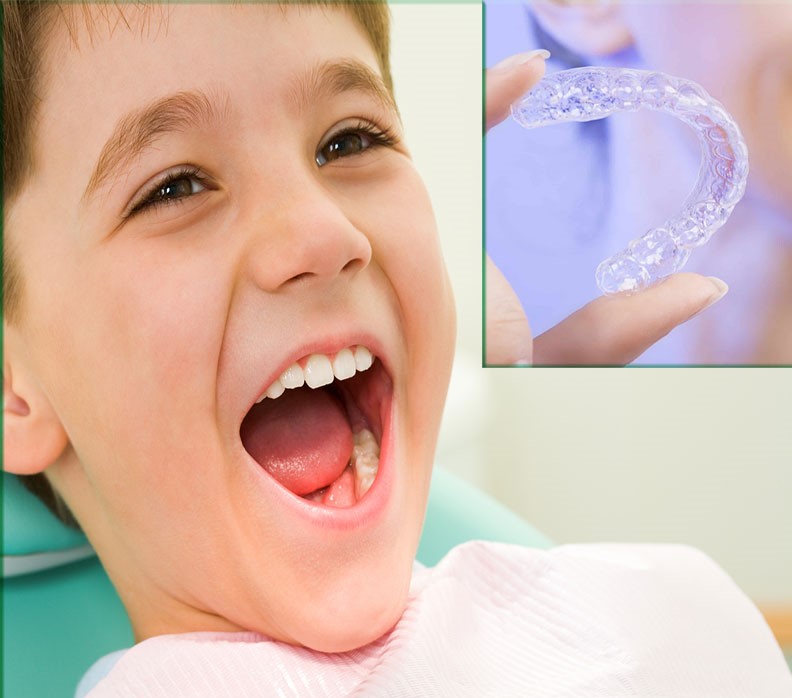Phương pháp niềng răng trong suốt cho trẻ