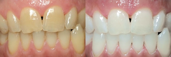 Tẩy trắng giúp răng trắng sáng trở lại