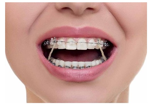 Niềng răng giúp bạn sở hữu hàm răng đẹp hơn