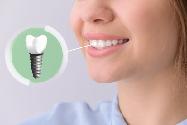 Tính thẩm mỹ cao của việc trồng răng implant