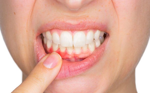 Nguyên nhân và cách khắc phục khi bị sưng nướu răng hàm dưới