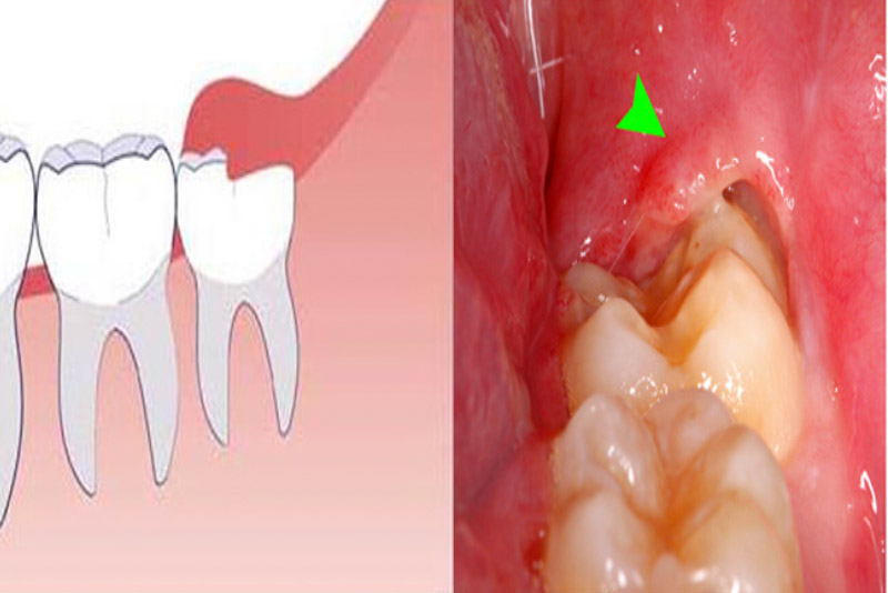 Khi mọc răng khôn thường có những triệu chứng khó chịu ở miệng, răng hàm