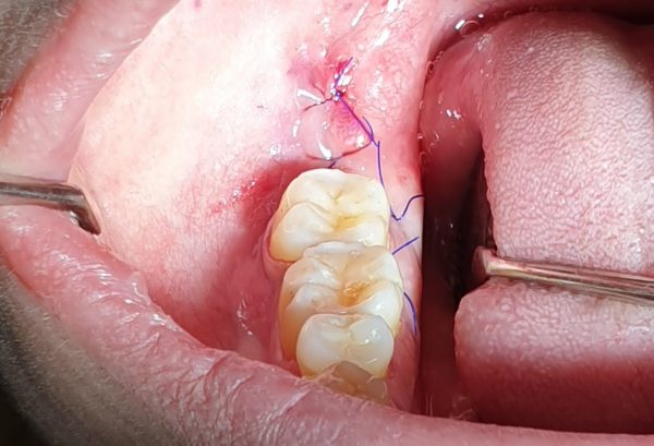 Răng khôn bị nhiễm trùng sau nhổ