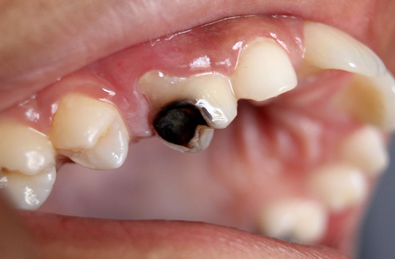 Dấu hiệu nhận biết sâu răng hàm trên