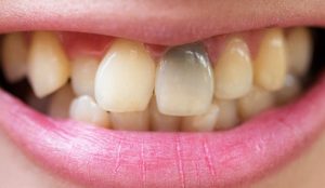 Răng chết tủy – Dấu hiệu và phương án điều trị