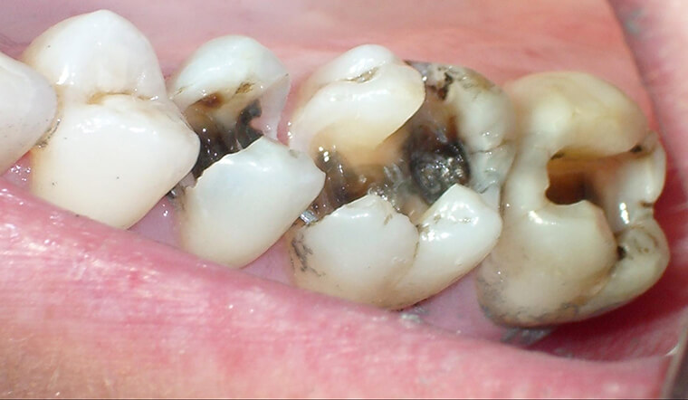 Răng bị sâu gây ra nhiều hậu quả nghiêm trọng