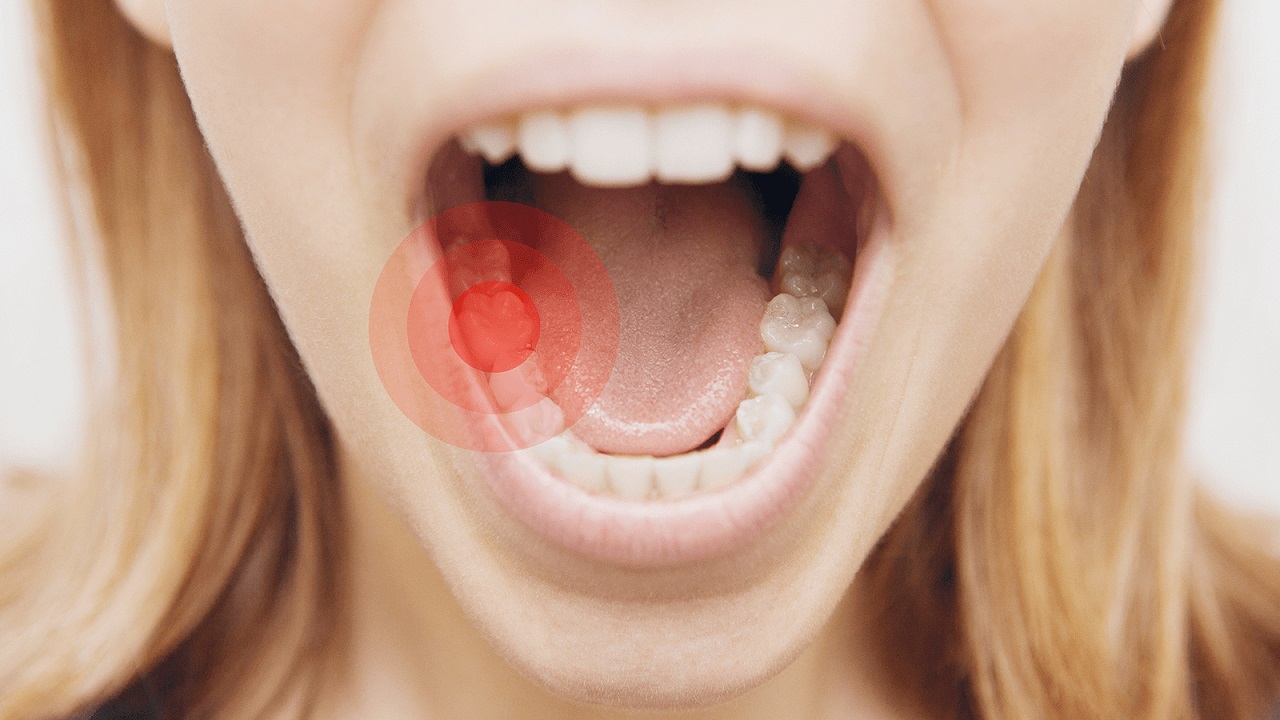 Có nhiều nguyên nhân làm răng bị sâu gây đau nhức