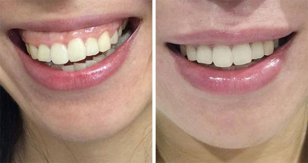 Niềng răng có chữa cười hở lợi được không?