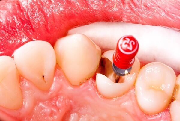 Răng chết tủy nếu được điều trị sớm sẽ không gây nguy hiểm