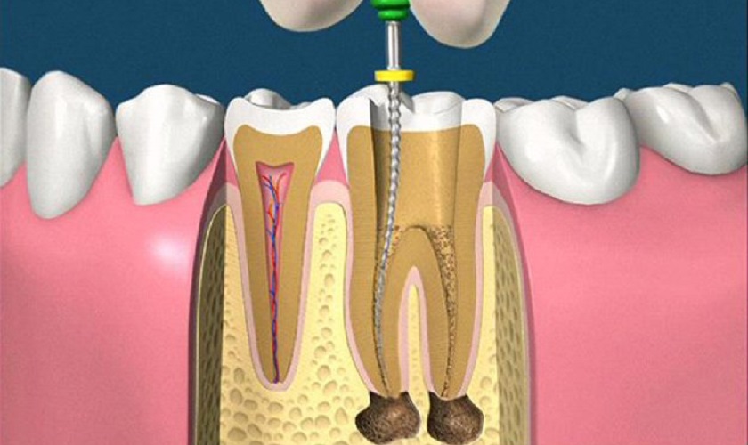 Cần phải lấy tủy răng bao nhiêu lần thì răng hết đau nhức và ê buốt?