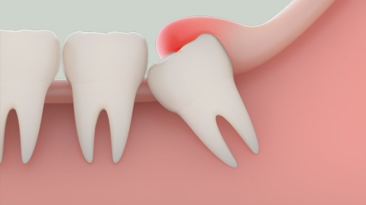 8 cách giảm đau khi mọc răng khôn nhanh chóng nhất 