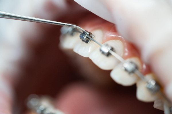 Niềng răng mắc cài là phương pháp niềng được sử dụng phổ biến nhất hiện nay