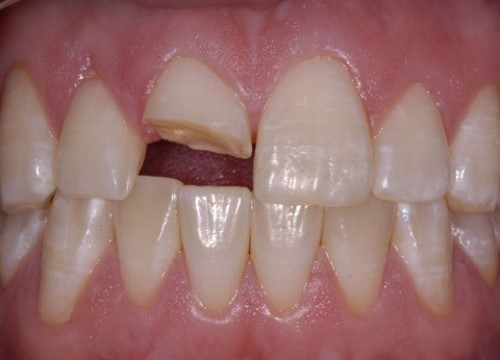 Răng bị gãy 1 nửa thân răng