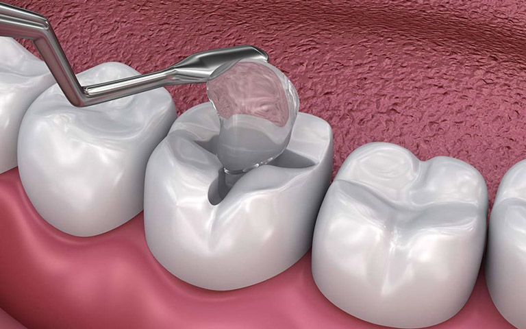 Tác hại của việc trám răng sai kỹ thuật mà bạn nên biết