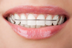 Quên đeo hàm duy trì có ảnh hưởng đến răng như thế nào?