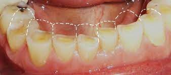 Nghiễn răng gây tổn thương xương hàm