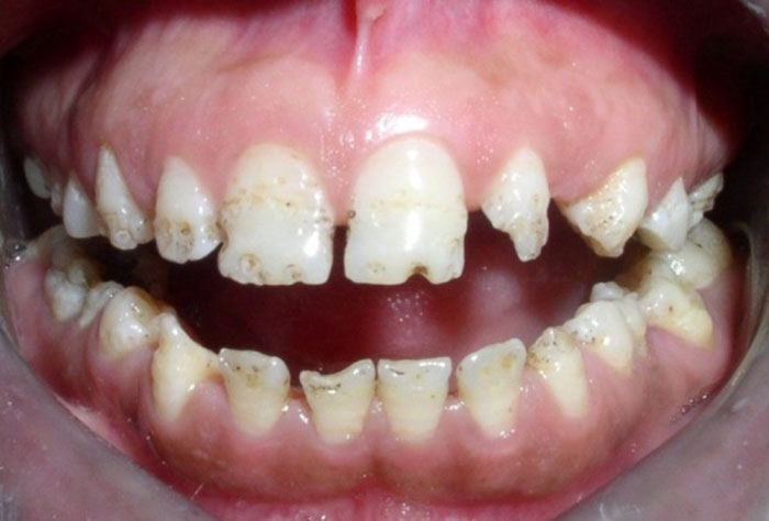 Thiếu sản men răng làm răng mỏng, yếu, chất lượng kém, dễ bị vi khuẩn dễ phá hủy