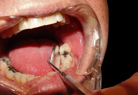 nhổ răng viêm tủy bằng máy sóng siêu âm