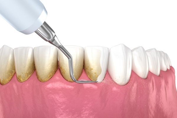 Làm sạch cao răng cũng làm một trong những cách giảm thiểu sưng nướu răng hàm dưới