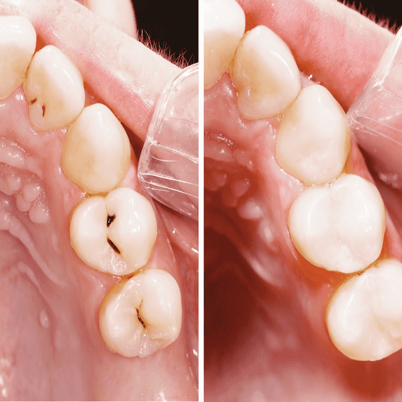 Sâu răng hàm trên được điều trị bằng trám răng khi phát hiện kịp thời