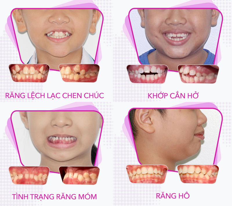 Những trường hợp này niềng răng sớm cho trẻ