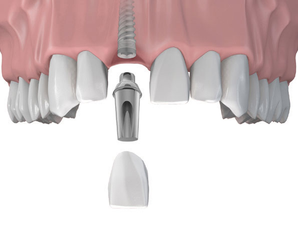 Dùng cấy ghép implant để khôi phục răng cửa