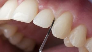 Các biến chứng của việc mài răng bọc sứ sai kỹ thuật
