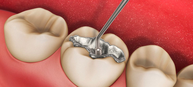 Giá của phương pháp hàn răng còn phụ thuộc rất nhiều vào vật liệu