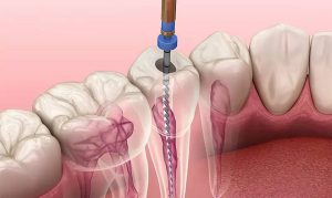 Lấy tủy răng có đau không và có làm ảnh hưởng đến sức khỏe?