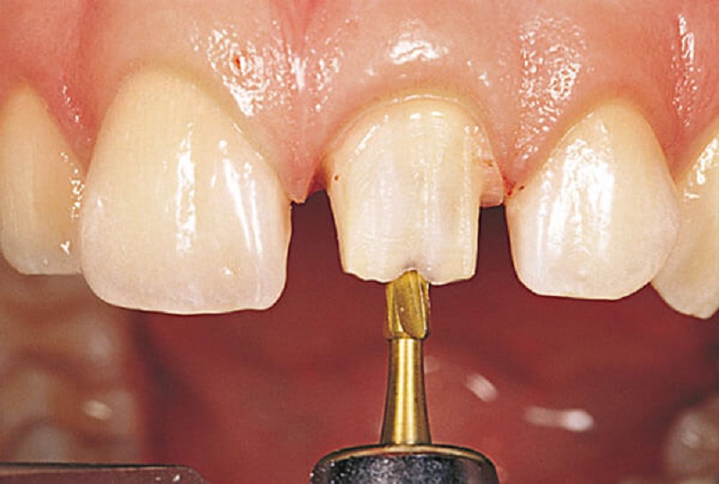 Cách mài cùi răng theo chuẩn quốc tế tại nha khoa Sea Dental