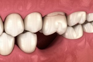 Mất răng bao lâu thì xương hàm sẽ bị tiêu?